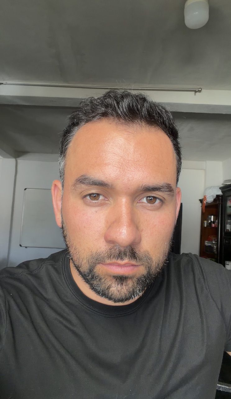 Josué de cerca el 11 de agosto de 2026 — línea del cabello y densidad actuales